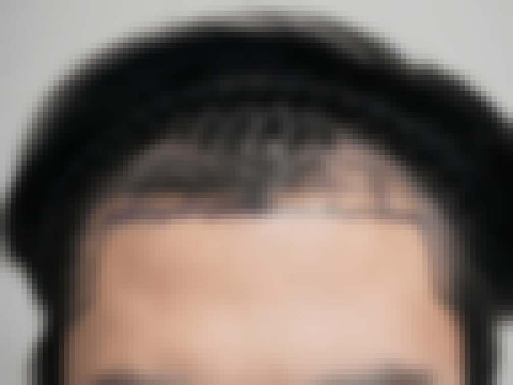 부산 비절개모발이식 수술 전과 6개월 경과 애니메이션