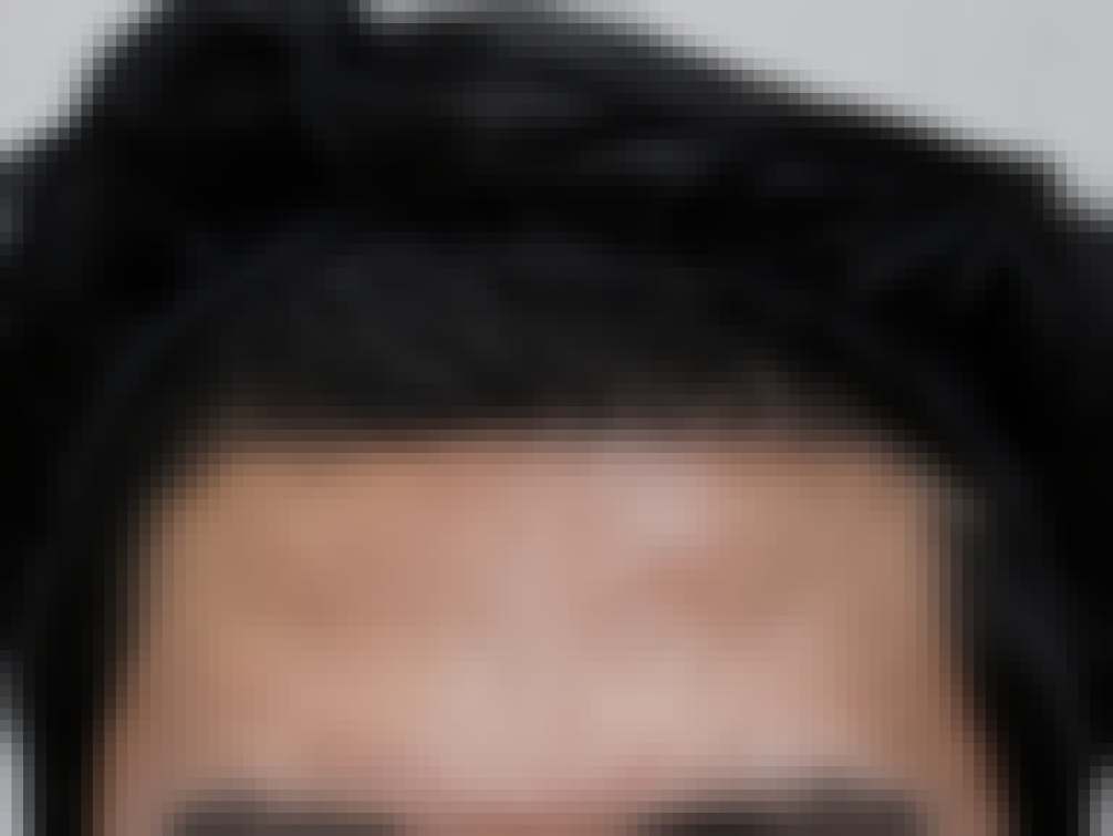 부산 비절개모발이식 6개월 경과 정면 사진