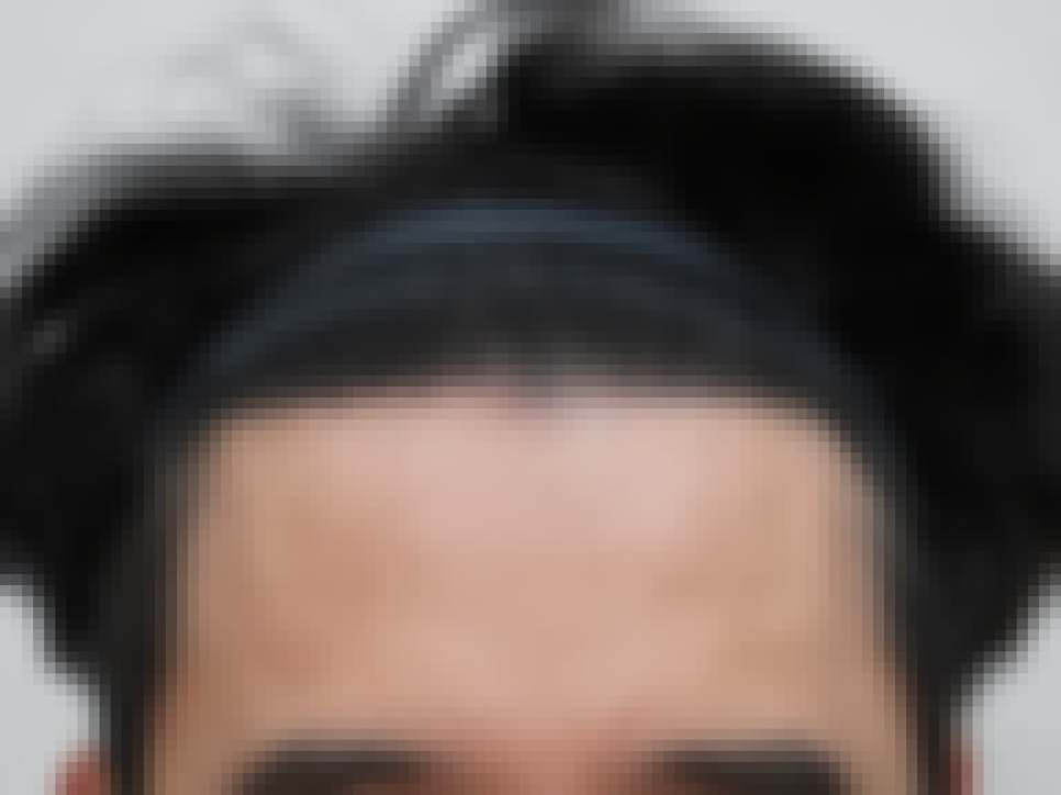 부산 비절개 모발이식 2500모 시술 1년 경과 정면 사진
