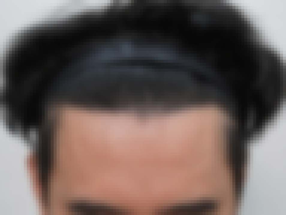 부산 비절개 모발이식 2500모 시술 1년 경과 정면 사진