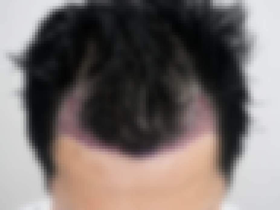 부산 비절개 모발이식 2500모 시술 직후 정면 사진