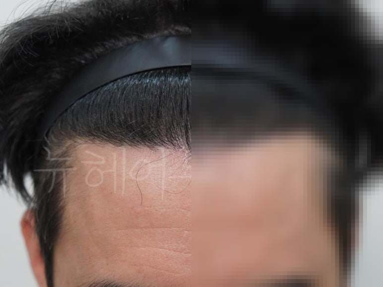 비절개 모발이식 2000모 시술 전후 사진 4