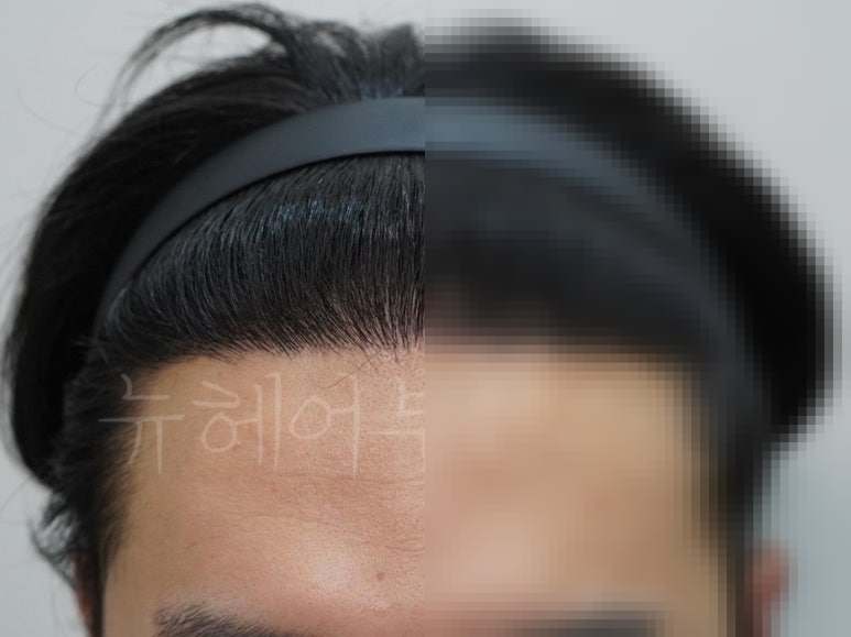 비절개 모발이식 2000모 시술 전후 사진 2