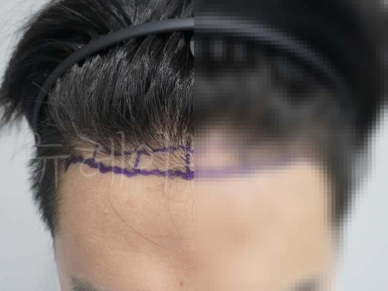 비절개 모발이식 2000모 시술 전후 사진 1
