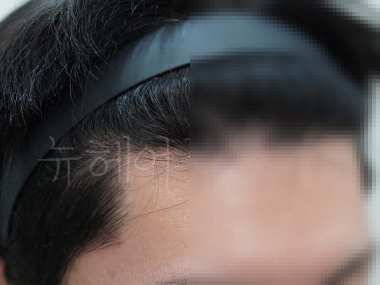비절개 모발이식 2000모 시술 전후 사진 2