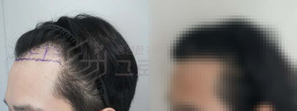 부산모발이식비용 3000모 결과