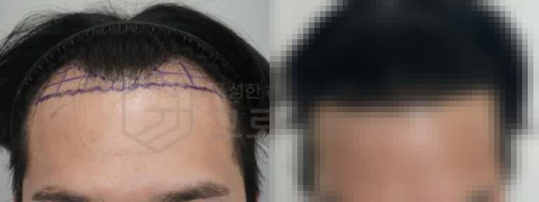 부산모발이식비용 3000모 결과