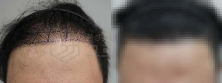 울산모발이식_재수술