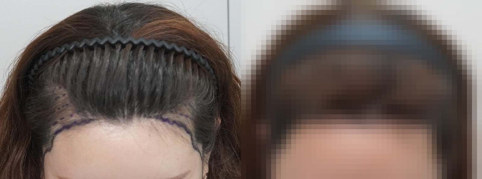 시술 전과 수술 1년 후 모발 상태 비교