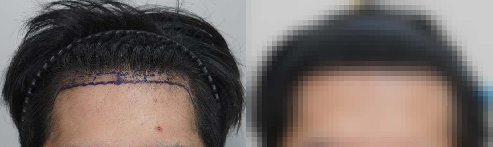 시술 전과 수술 1년 후 모발 상태 비교