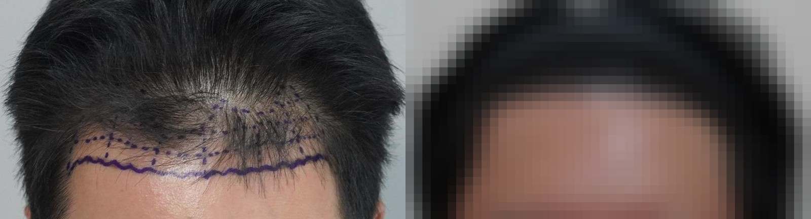 시술 전과 수술 1년 후 모발 상태 비교