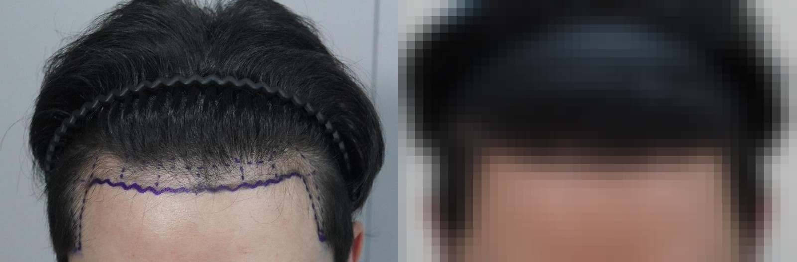 시술 전과 수술 1년 후 모발 상태 비교