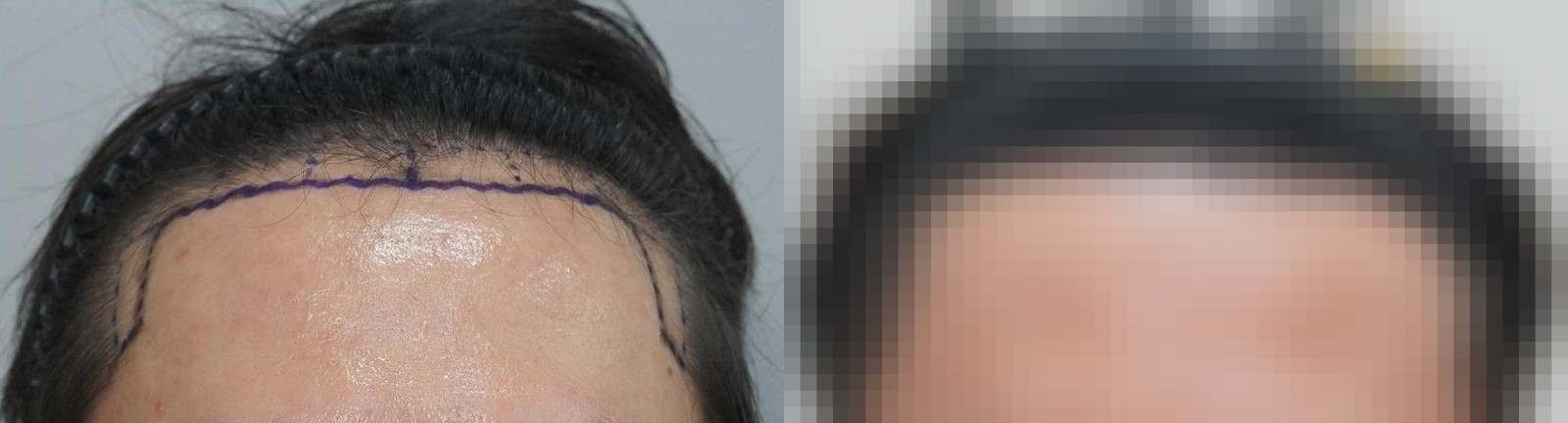 시술 전과 수술 1년 후 모발 상태 비교