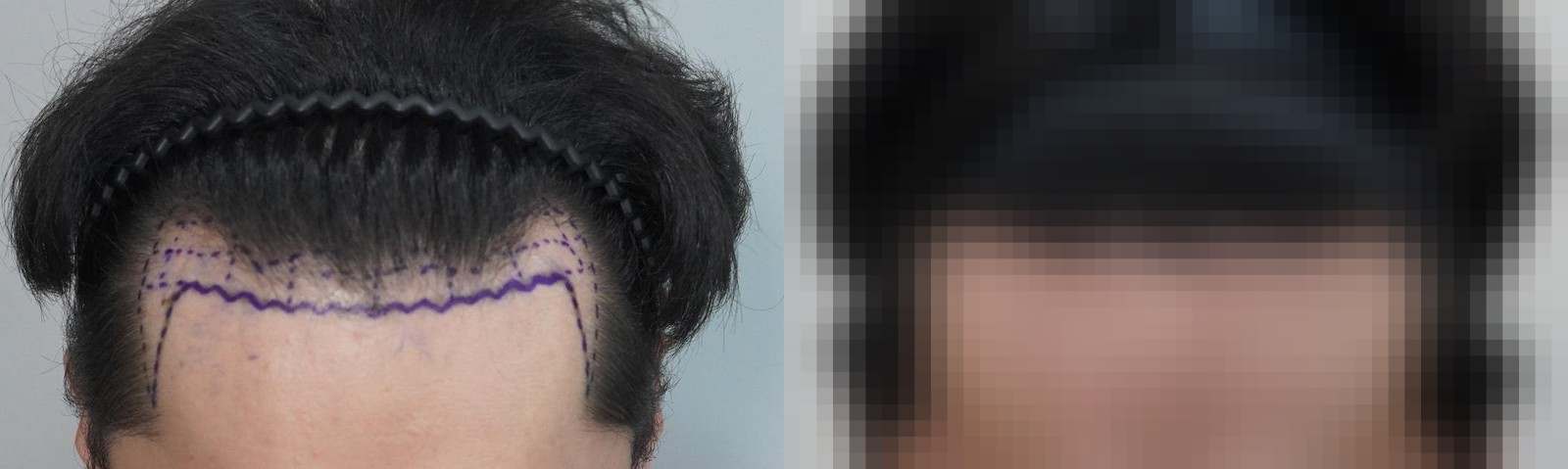 시술 전과 수술 1년 후 모발 상태 비교