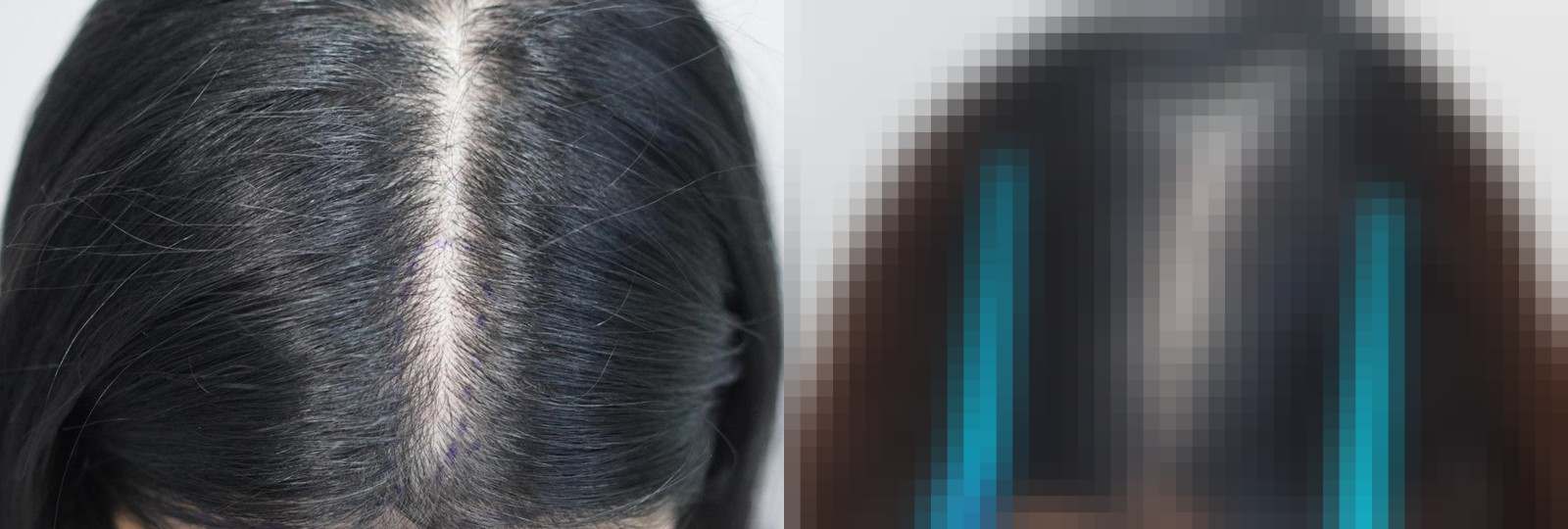 시술 전과 수술 1년 후 모발 상태 비교