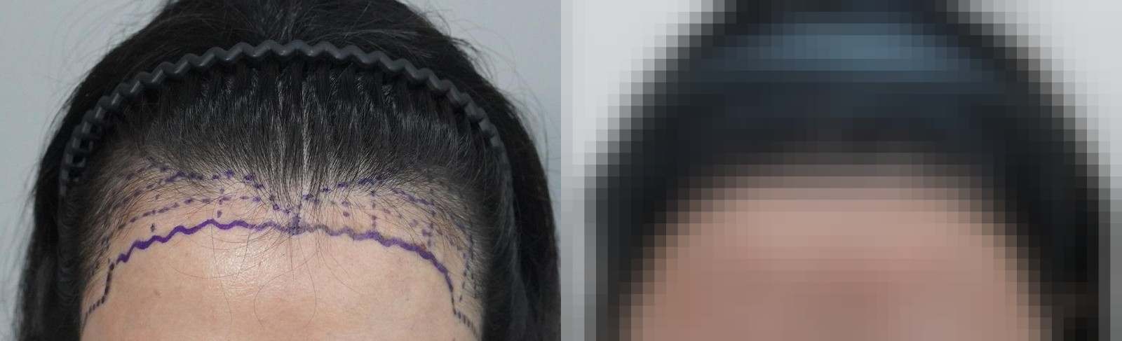 시술 전과 수술 1년 후 모발 상태 비교