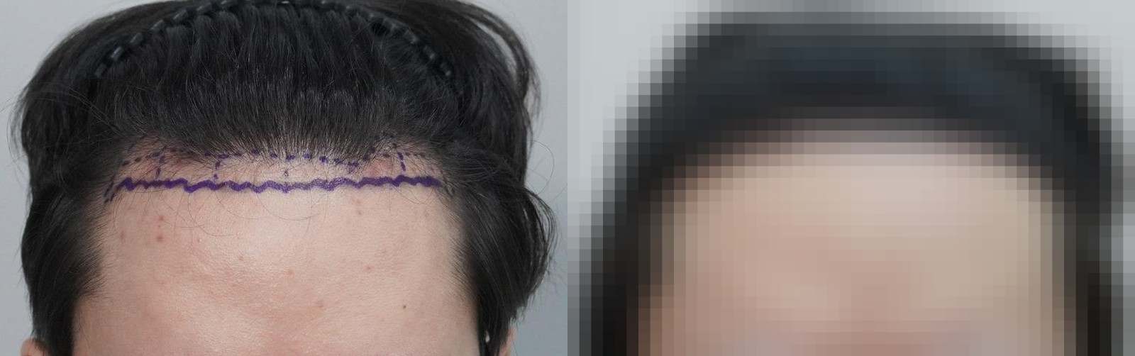 시술 전과 수술 1년 후 모발 상태 비교