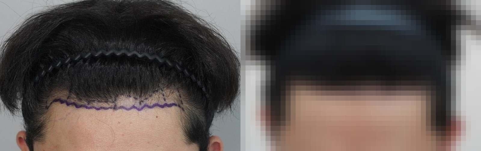 시술 전과 수술 1년 후 모발 상태 비교