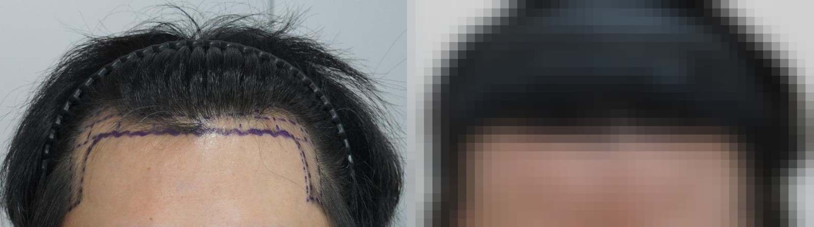 시술 전과 수술 1년 후 모발 상태 비교