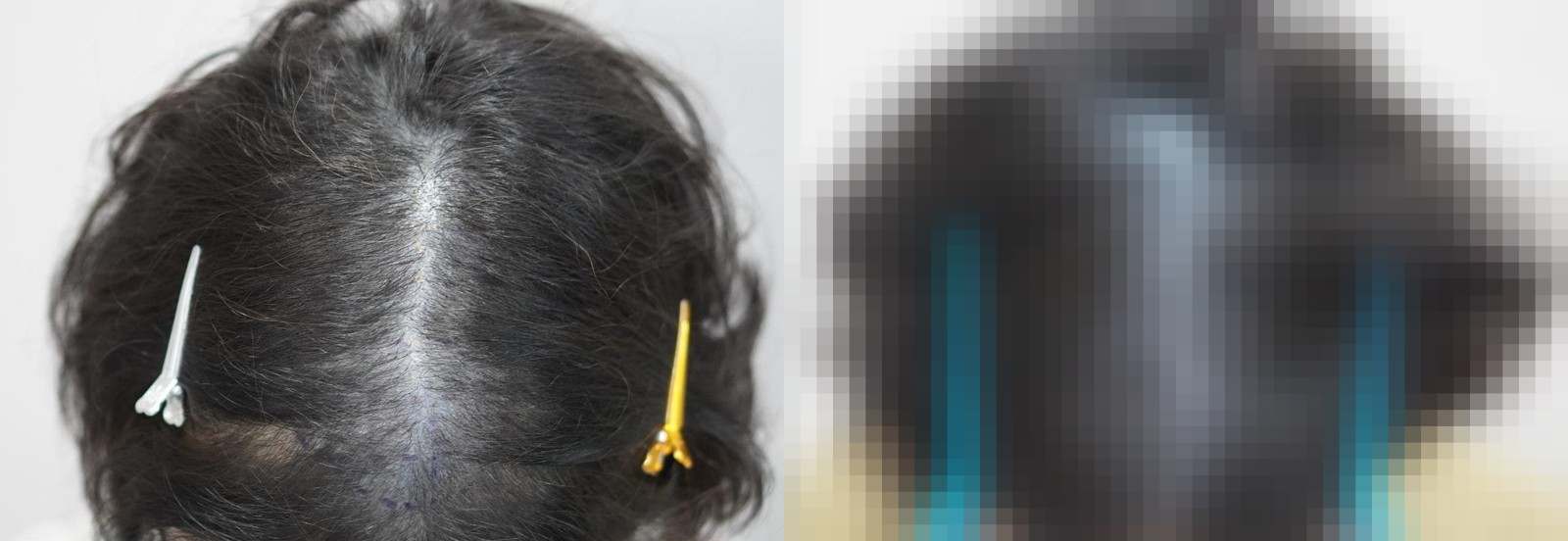 시술 전과 수술 1년 후 모발 상태 비교