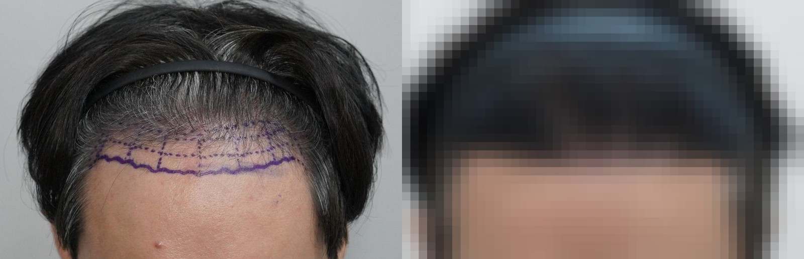 시술 전과 수술 1년 후 모발 상태 비교