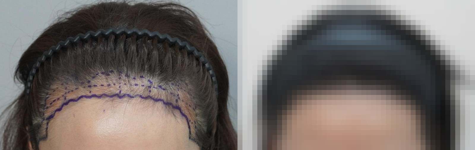 시술 전과 수술 1년 후 모발 상태 비교