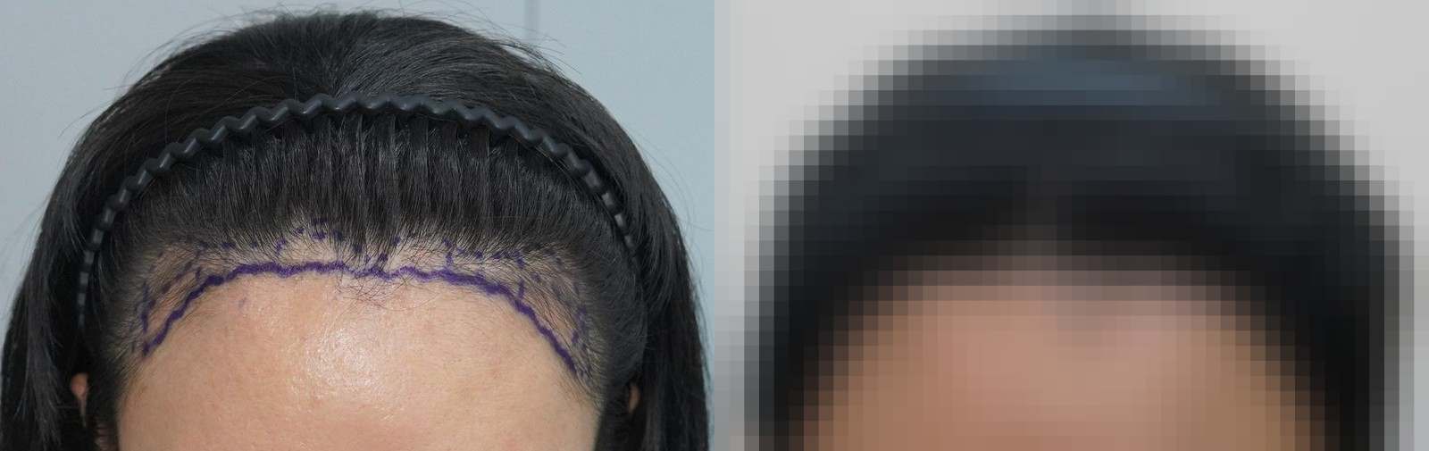 시술 전과 수술 1년 후 모발 상태 비교