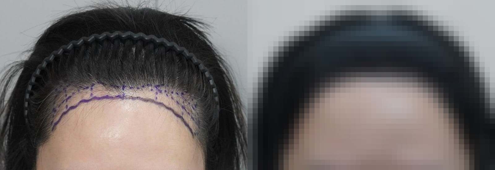 시술 전과 수술 1년 후 모발 상태 비교