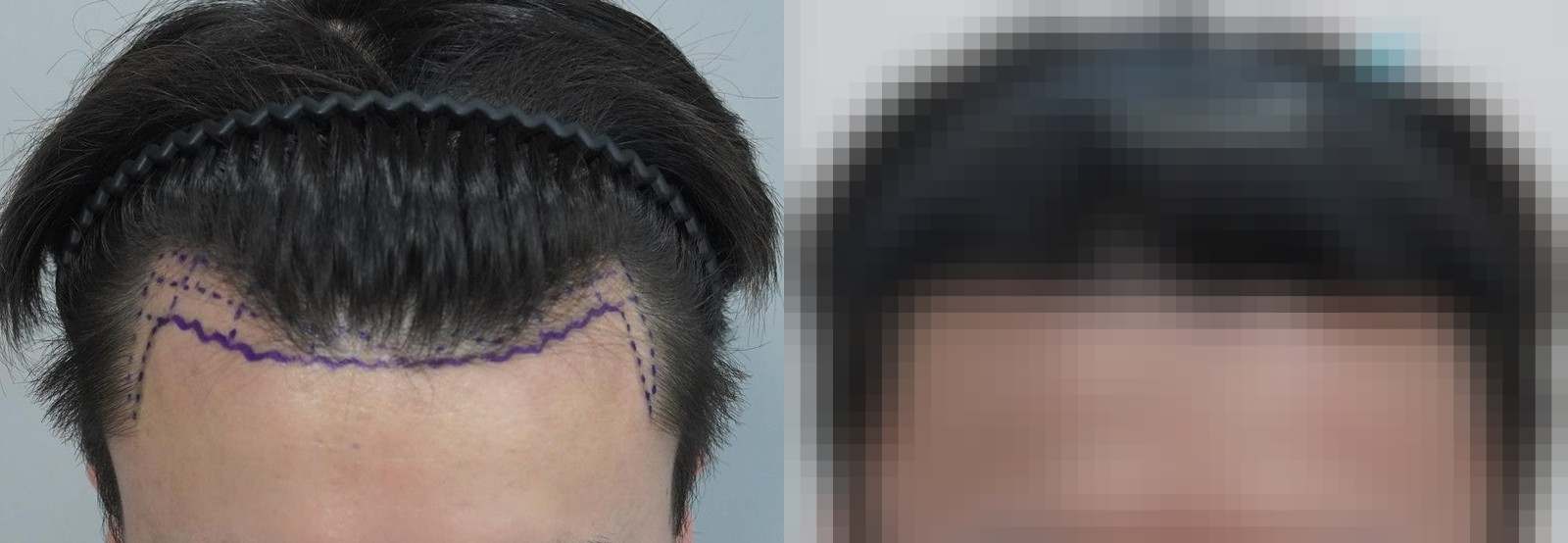 시술 전과 수술 1년 후 모발 상태 비교