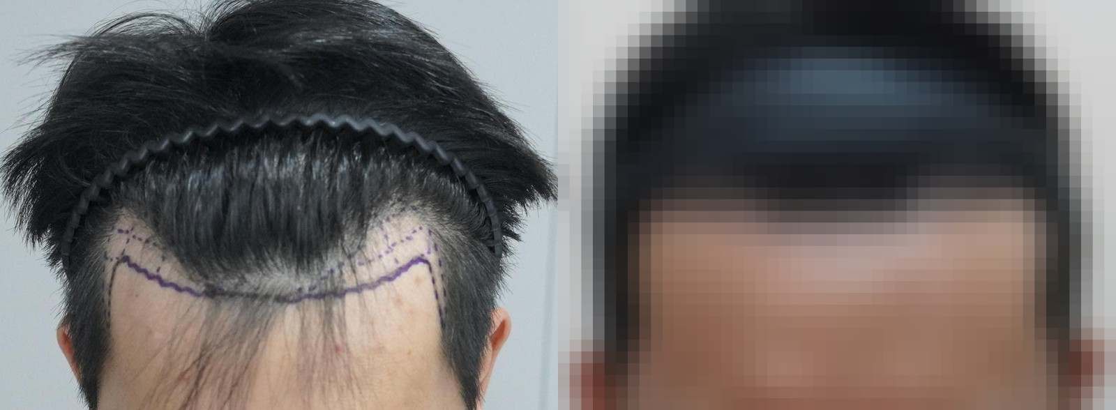시술 전과 수술 1년 후 모발 상태 비교