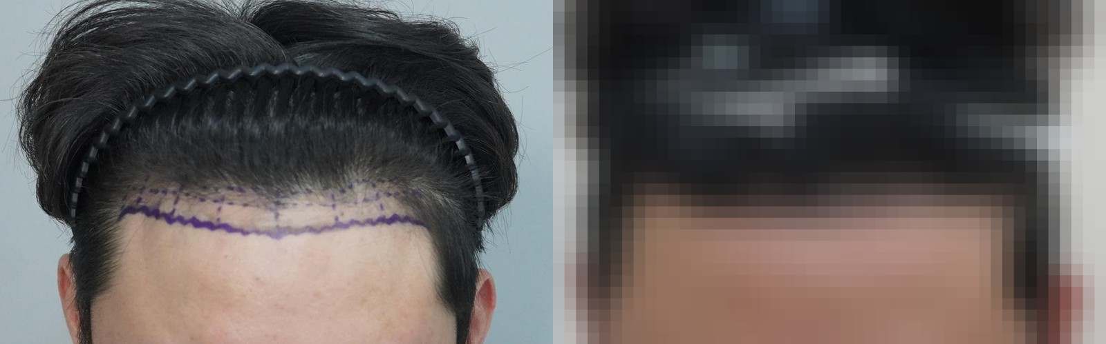 시술 전과 수술 1년 후 모발 상태 비교