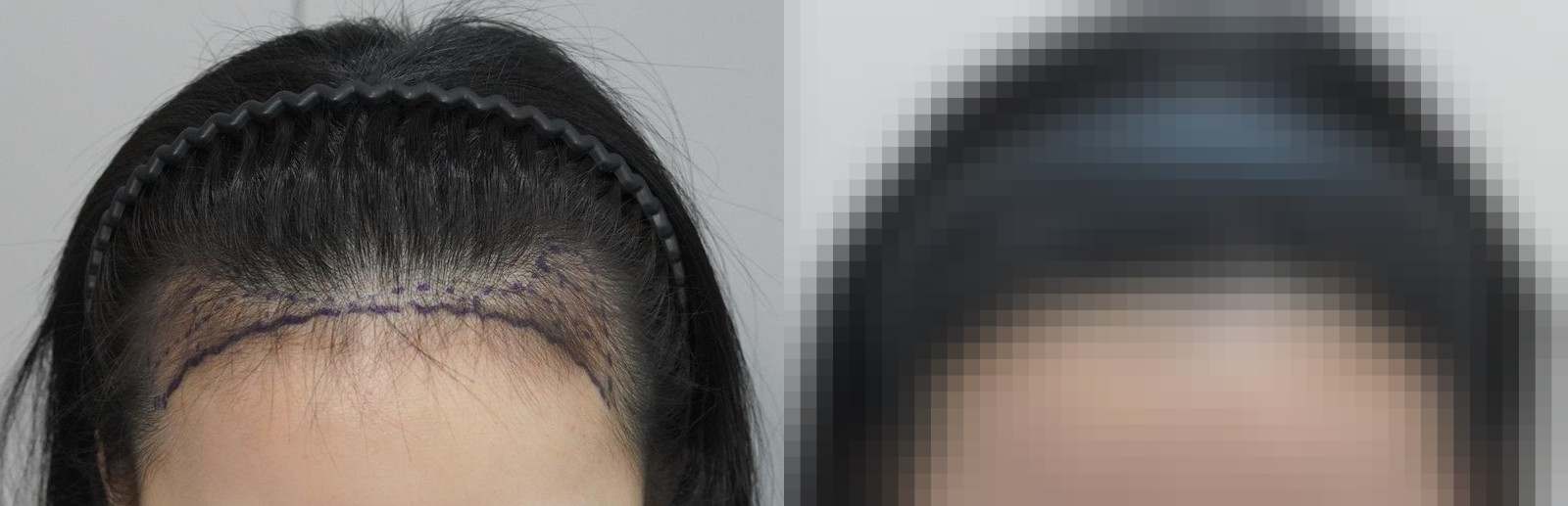 시술 전과 수술 1년 후 모발 상태 비교