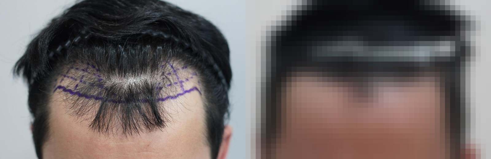 시술 전과 수술 1년 후 모발 상태 비교
