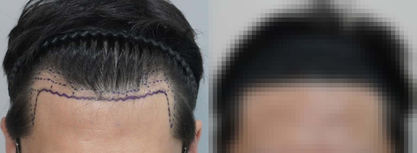 시술 전과 수술 1년 후 모발 상태 비교