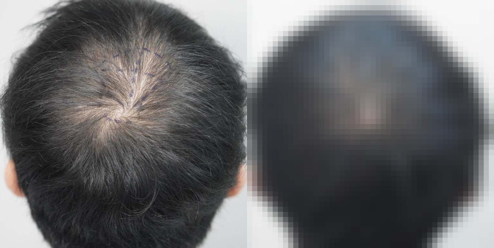시술 전과 수술 1년 후 모발 상태 비교