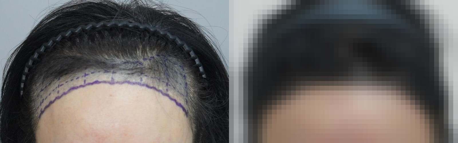 시술 전과 수술 1년 후 모발 상태 비교