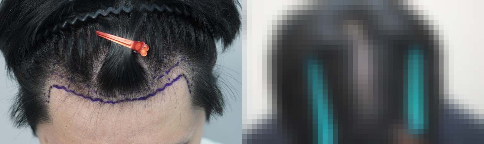 시술 전과 수술 1년 후 모발 상태 비교