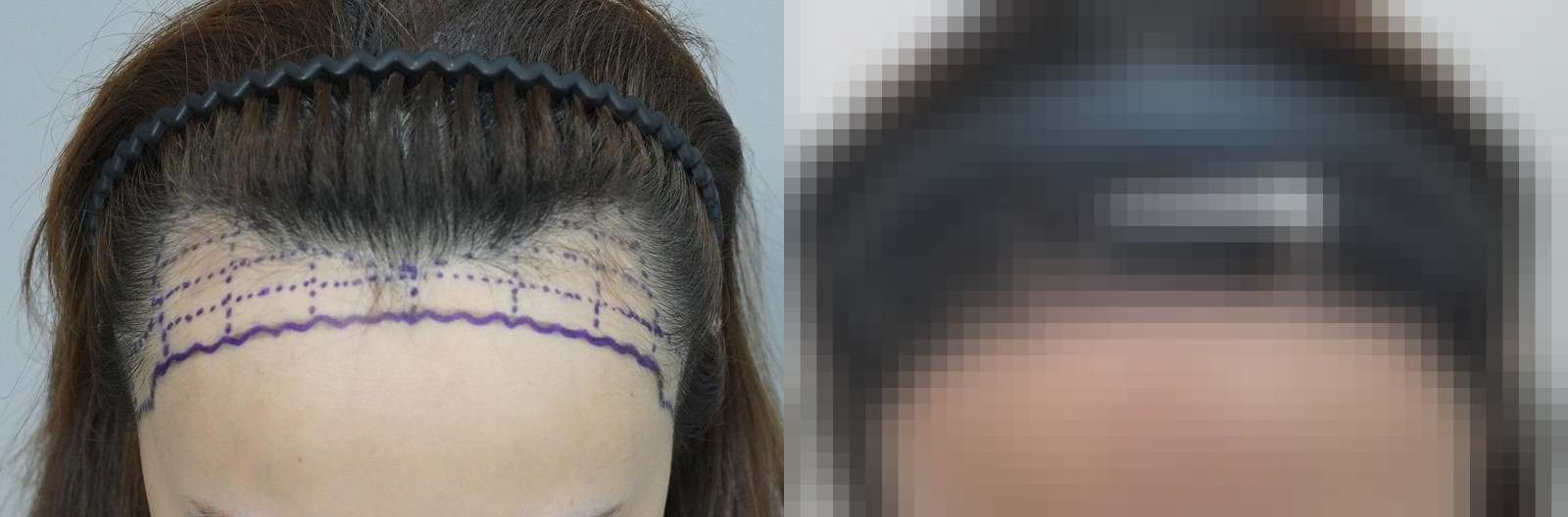시술 전과 수술 1년 후 모발 상태 비교