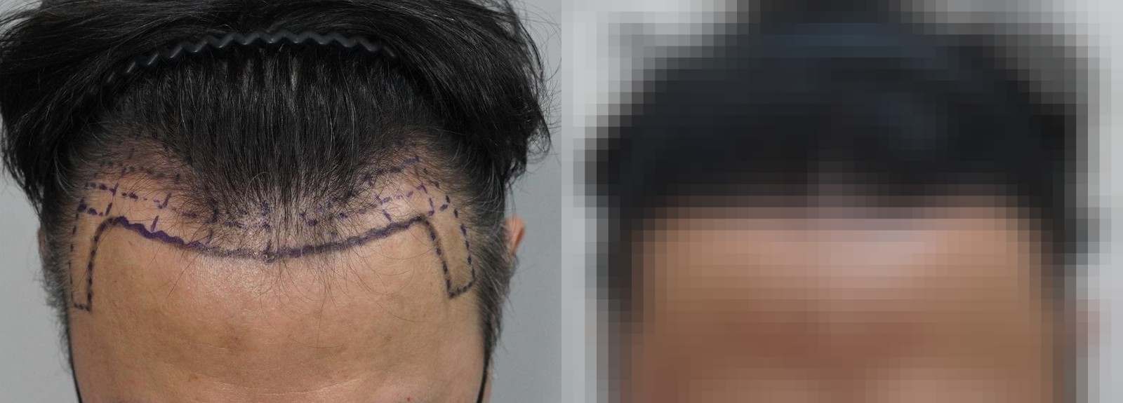 시술 전과 수술 1년 후 모발 상태 비교