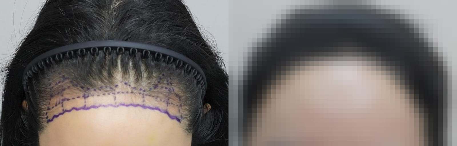 시술 전과 수술 1년 후 모발 상태 비교