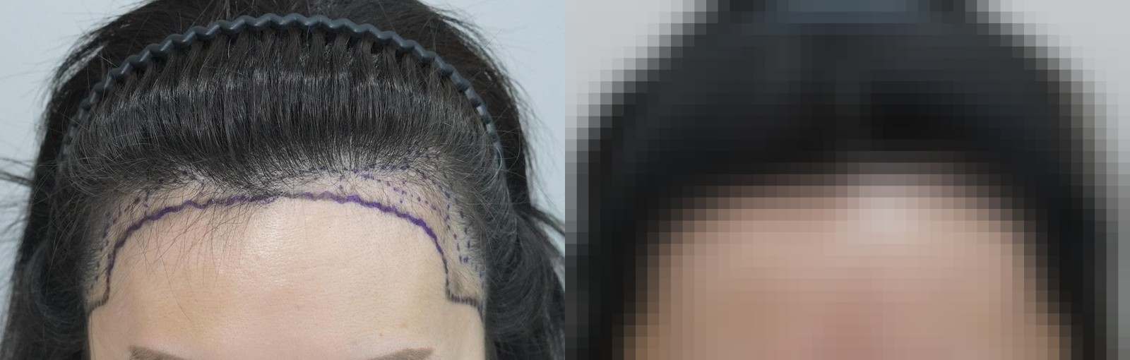 시술 전과 수술 1년 후 모발 상태 비교