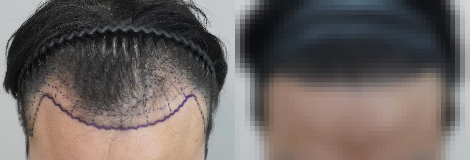 시술 전과 수술 1년 후 모발 상태 비교