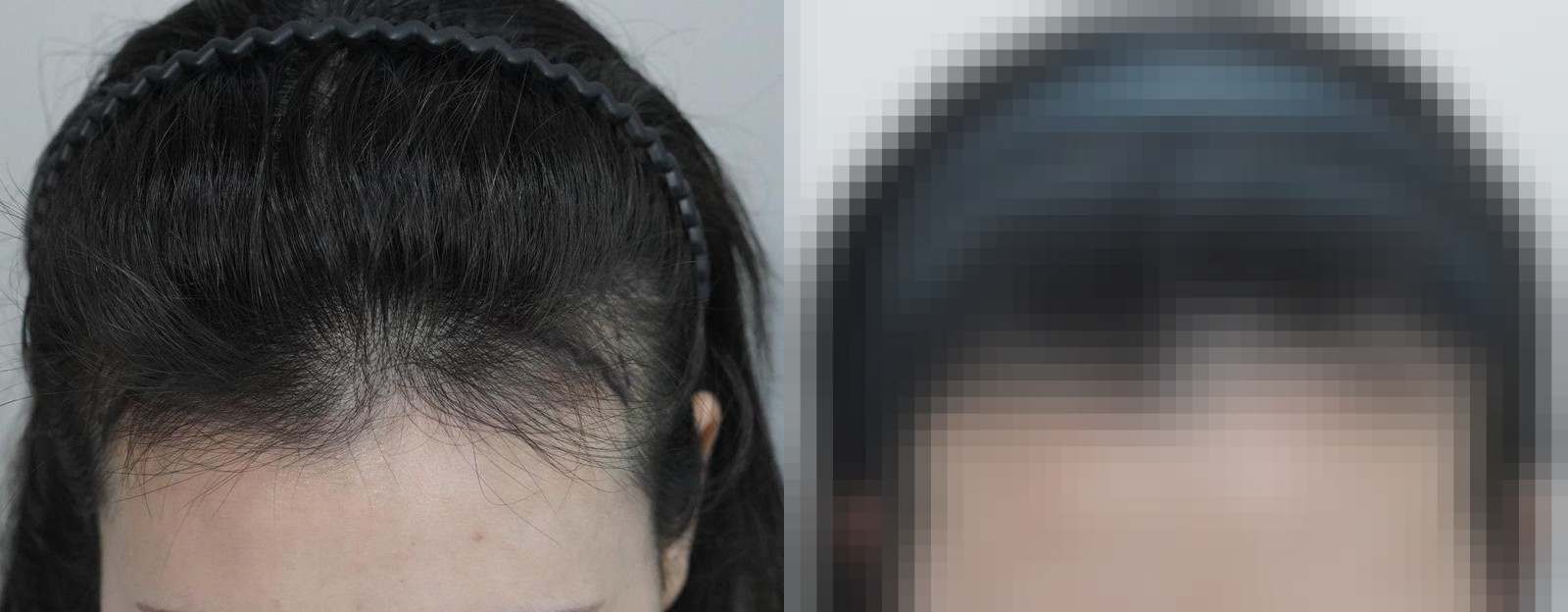 시술 전과 수술 1년 후 모발 상태 비교