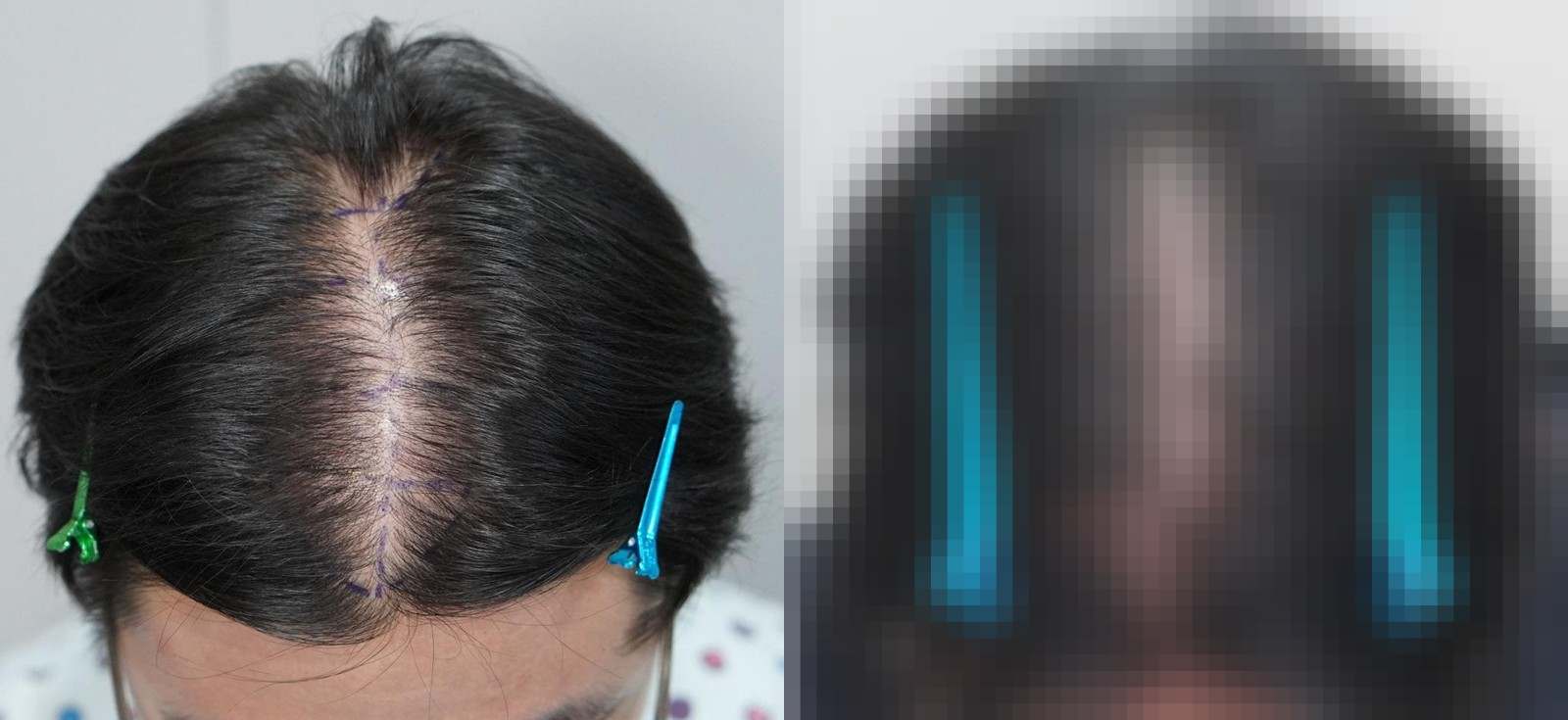 시술 전과 수술 1년 후 모발 상태 비교