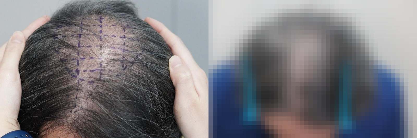 시술 전과 수술 1년 후 모발 상태 비교