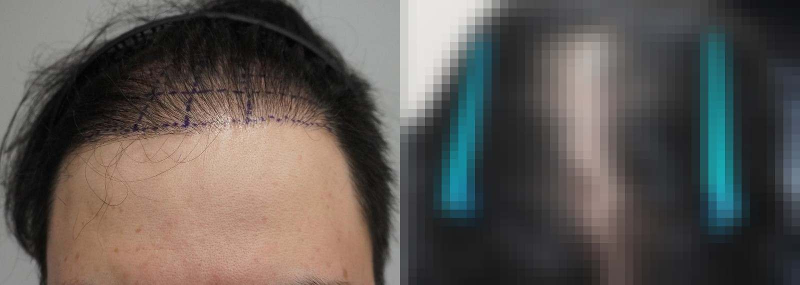 시술 전과 수술 1년 후 모발 상태 비교