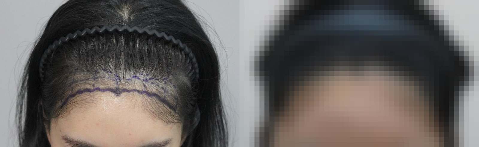 시술 전과 수술 1년 후 모발 상태 비교