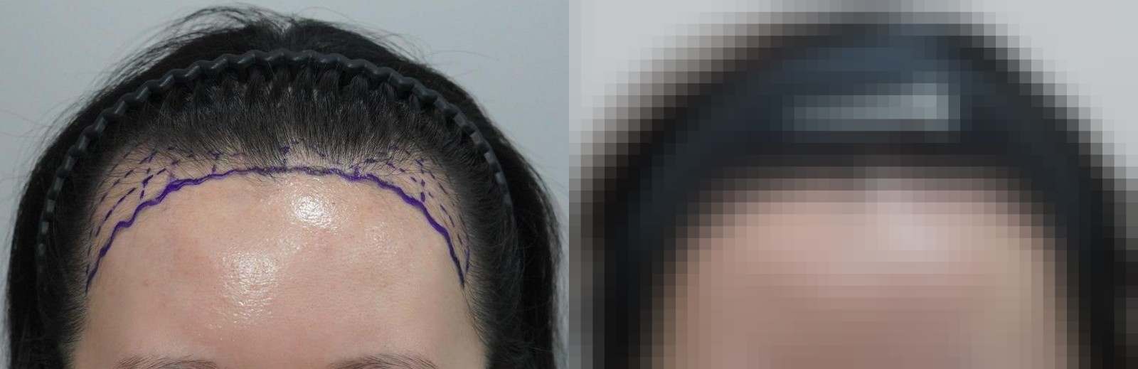 시술 전과 수술 1년 후 모발 상태 비교