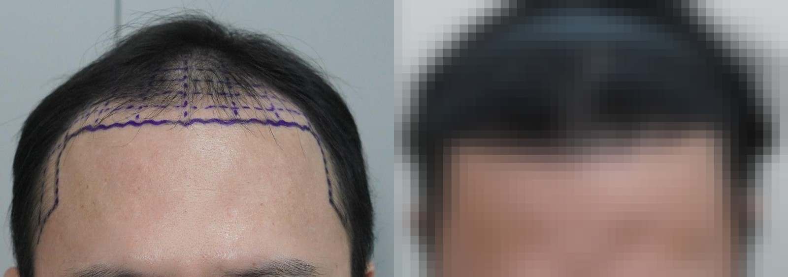 시술 전과 수술 1년 후 모발 상태 비교