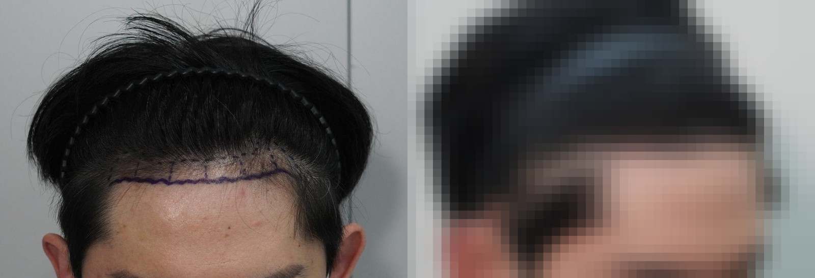 시술 전과 수술 1년 후 모발 상태 비교